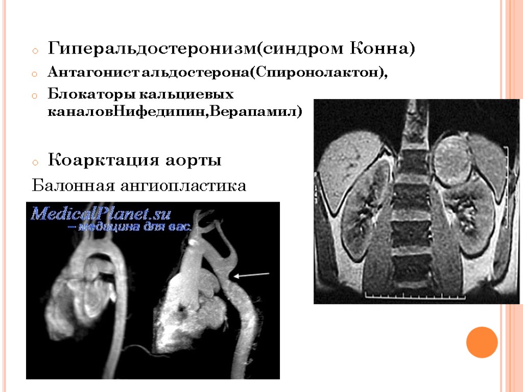 Гиперальдостеронизм(синдром Конна) Антагонист альдостерона(Спиронолактон), Блокаторы кальциевых каналовНифедипин,Верапамил) Коарктация аорты Балонная ангиопластика